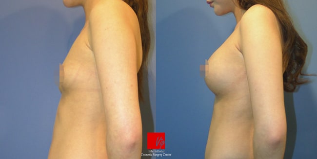 Breast Surgery, Body Contouring - Nâng ngực bằng túi độn