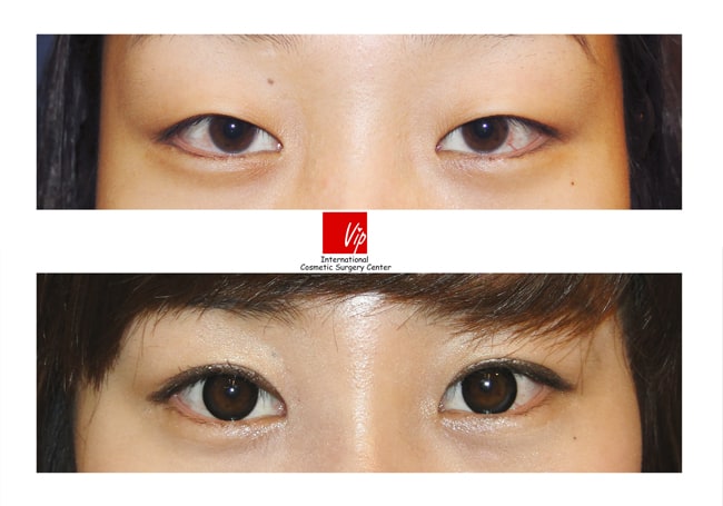Eye Surgery - Phẫu thuật sa mí mắt