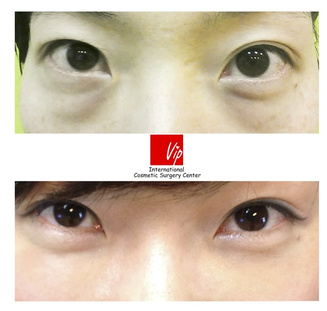 Eye Surgery - Sắp xếp mỡ bên dưới mắt