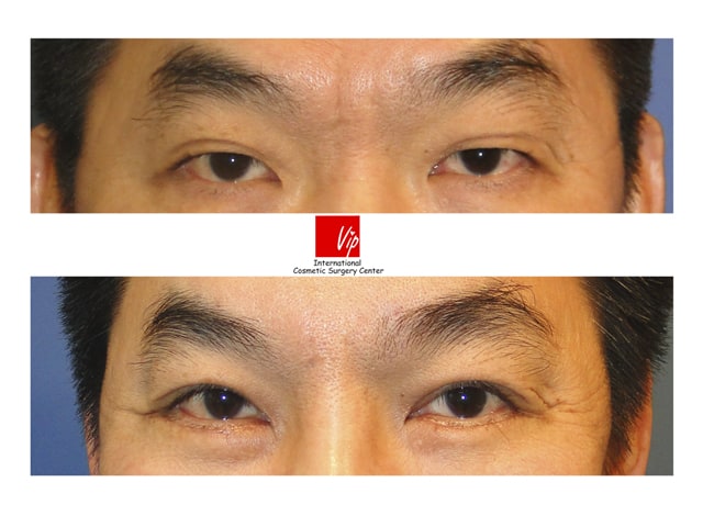 Eye Surgery - Phẫu thuật nâng trán nội soi, Phẫu thuật mí mắt trên