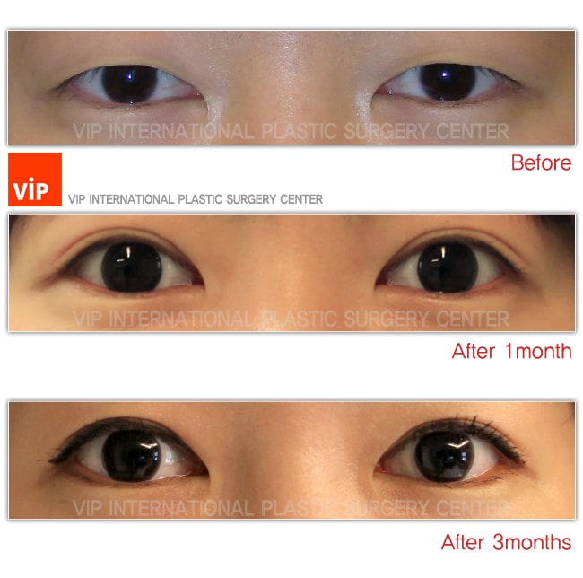 Eye Surgery - Phẫu thuật sa mí mắt