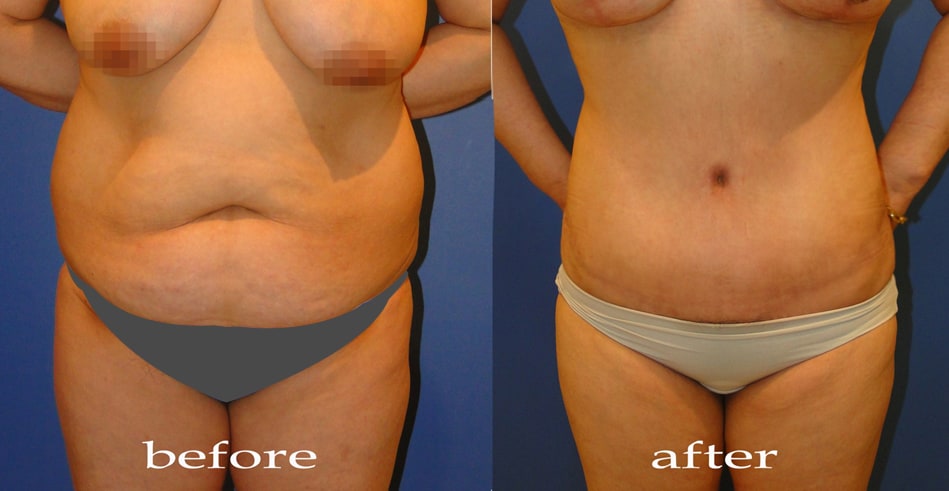 Body Contouring - Hút mỡ