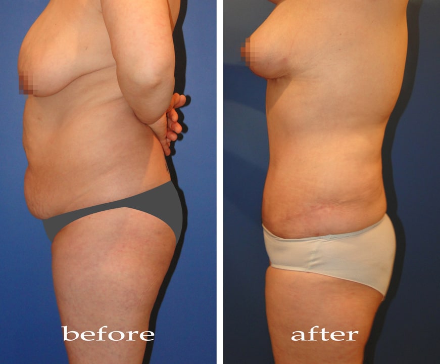 Body Contouring - Hút mỡ