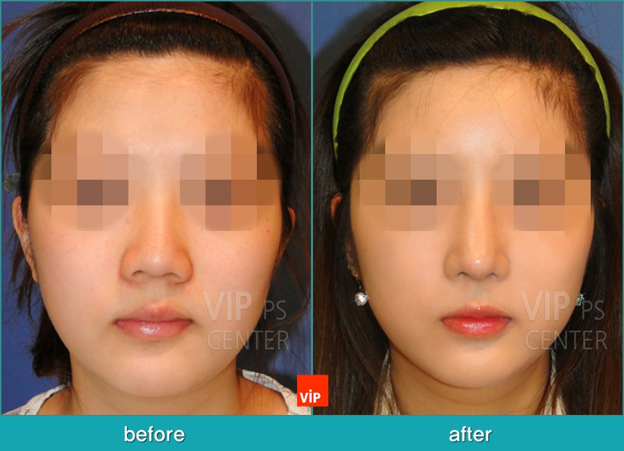 Nose Surgery - Chỉnh hình mũi lệch vách ngăn