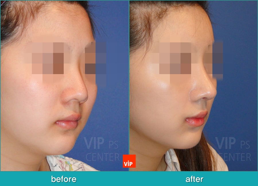 Nose Surgery - Chỉnh hình mũi lệch vách ngăn
