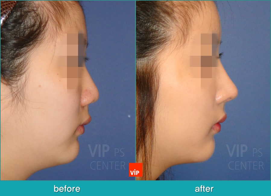 Nose Surgery - Chỉnh hình mũi lệch vách ngăn