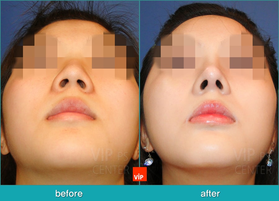 Nose Surgery - Chỉnh hình mũi lệch vách ngăn