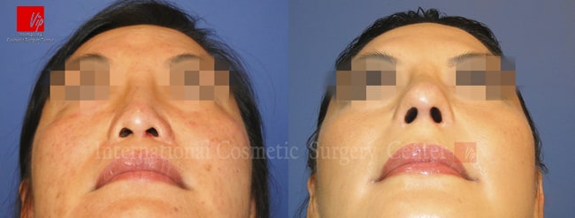 	Harmony-Rhinoplasty, Protruded Mouth Correction Rhinoplasty, Revision Rhinoplasty	 - Harmony rhinoplasty  using Rib cartilage