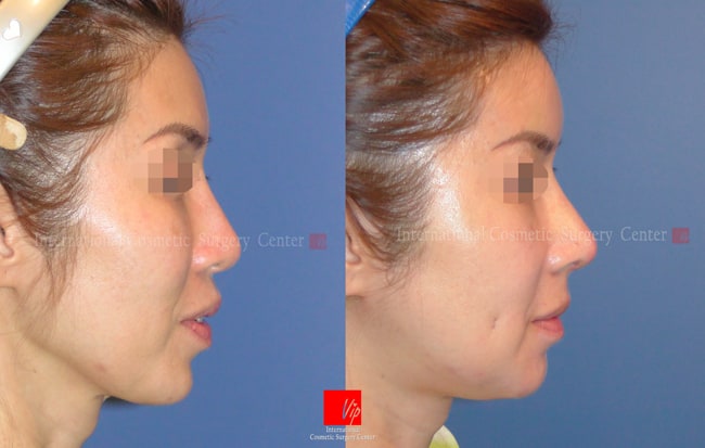 Nose Surgery - Tái phẫu thuật mũi bằng sụn sườn