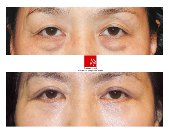 Eye Surgery - Phẫu thuật bên dưới mắt