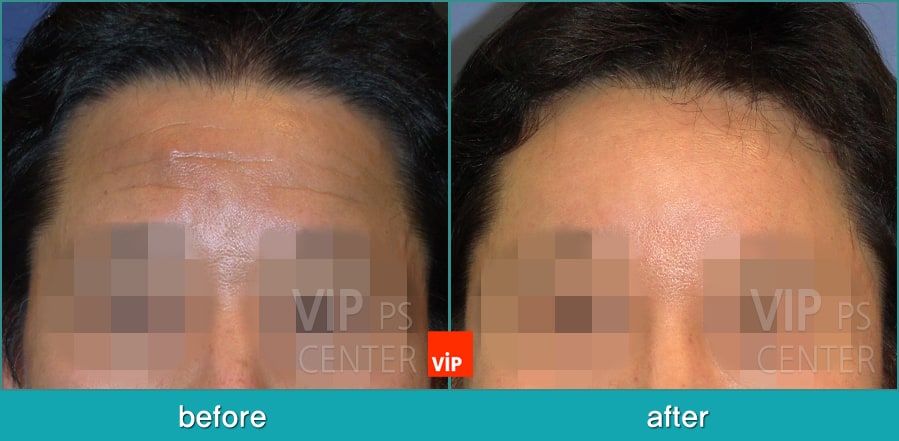 Face Lift, Stem Cell Fat Graft - Phẫu thuật nâng trán nội soi