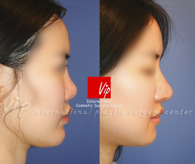 	Harmony-Rhinoplasty, Protruded Mouth Correction Rhinoplasty, Contracted Nose	 - Ribcartilage rhinoplasty - Improvement of mouth protrusion