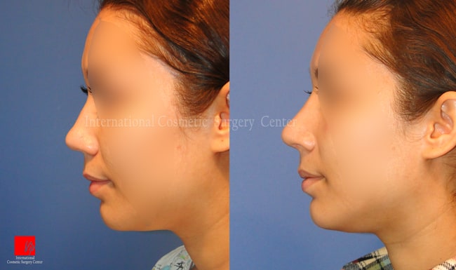 Nose Surgery - Mũi tẹt