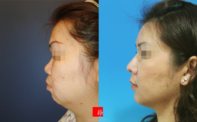Nose Surgery, Facial Bone Surgery - Phẫu thuật làm khuôn mặt hài hòa (Phẫu thuật nâng mũi bằng sụn sườn, Trượt cằm)