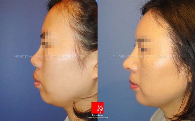 Nose Surgery - Tái phẫu thuật mũi bằng sụn sườn