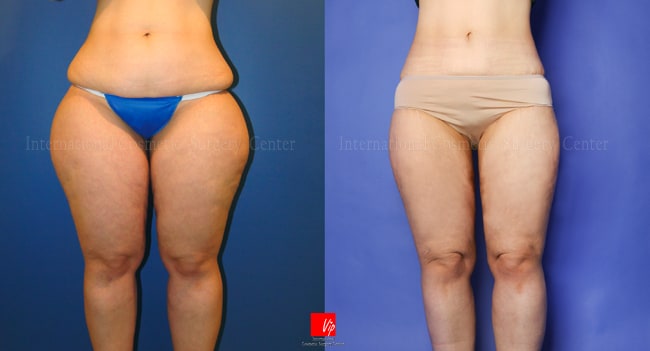 Body Contouring - Hút mỡ