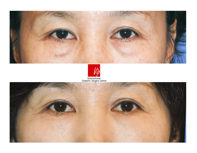Eye Surgery - Phẫu thuật bên dưới mắt