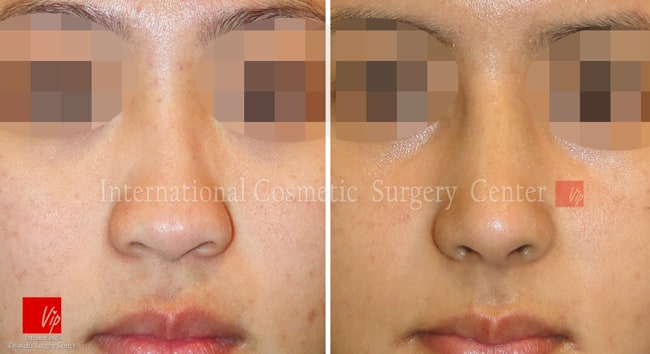 	Nose Surgery, Rib cartilage Rhinoplasty, Stem Cell Fat Graft	 - Autologous Rhinoplasty and Fat graft