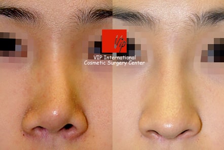 	Septal Deviation	 - Smart rhinoplasty - Septal deviation correction + Cosmetic surgery