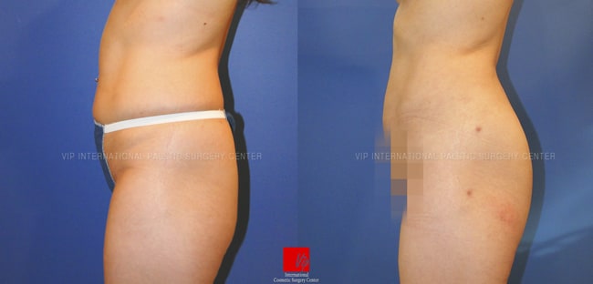 Stem Cell Fat Graft, Body Contouring - Phẫu thuật nâng mông