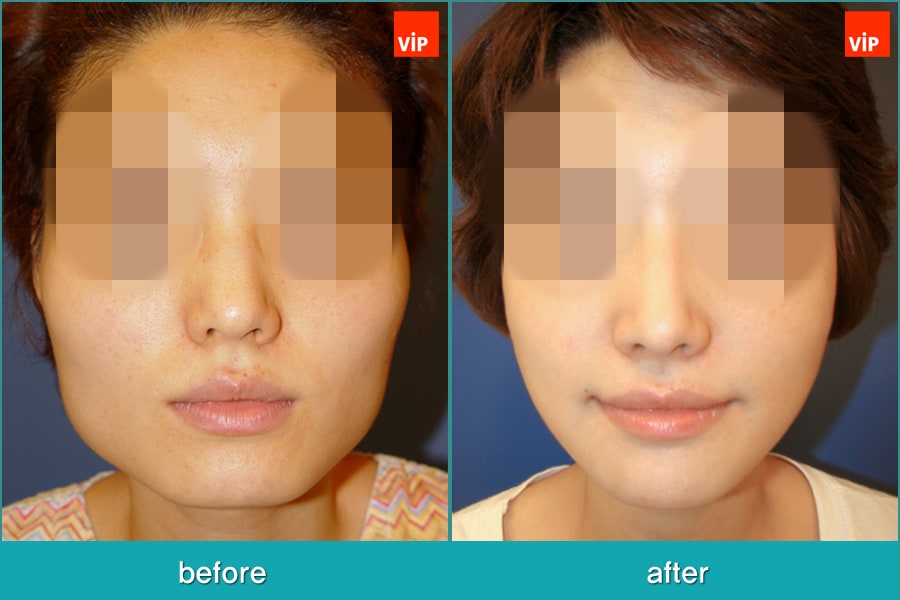 Nose Surgery, Facial Bone Surgery - Nâng mũi bằng sụn vách ngăn, Phẫu thuật tạo đường nét trên khuôn mặt, Phẫu thuật gọt hàm, Hạ gò má