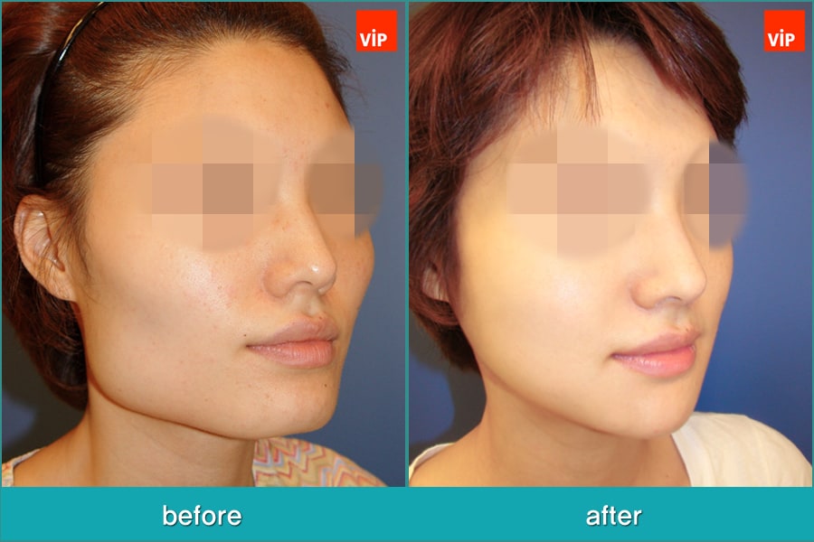 Nose Surgery, Facial Bone Surgery - Nâng mũi bằng sụn vách ngăn, Phẫu thuật tạo đường nét trên khuôn mặt, Phẫu thuật gọt hàm, Hạ gò má