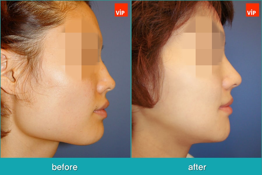 Nose Surgery, Facial Bone Surgery - Nâng mũi bằng sụn vách ngăn, Phẫu thuật tạo đường nét trên khuôn mặt, Phẫu thuật gọt hàm, Hạ gò má