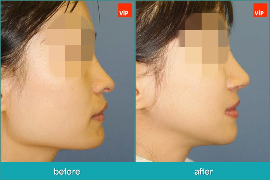 Nose Surgery, Facial Bone Surgery - Nâng mũi bằng sụn sườn, Phẫu thuật tạo đường nét trên khuôn mặt, Phẫu thuật gọt hàm