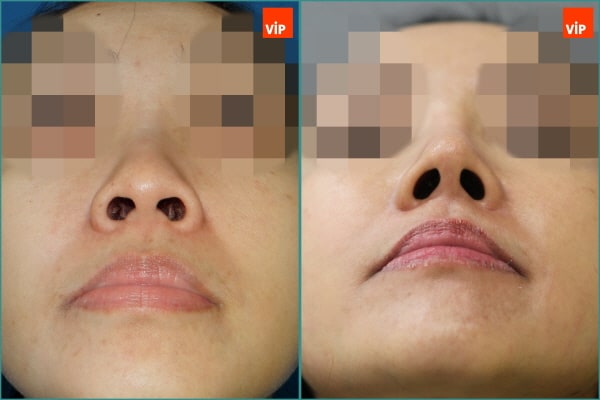 Nose Surgery - Nâng mũi bằng sụn sườn