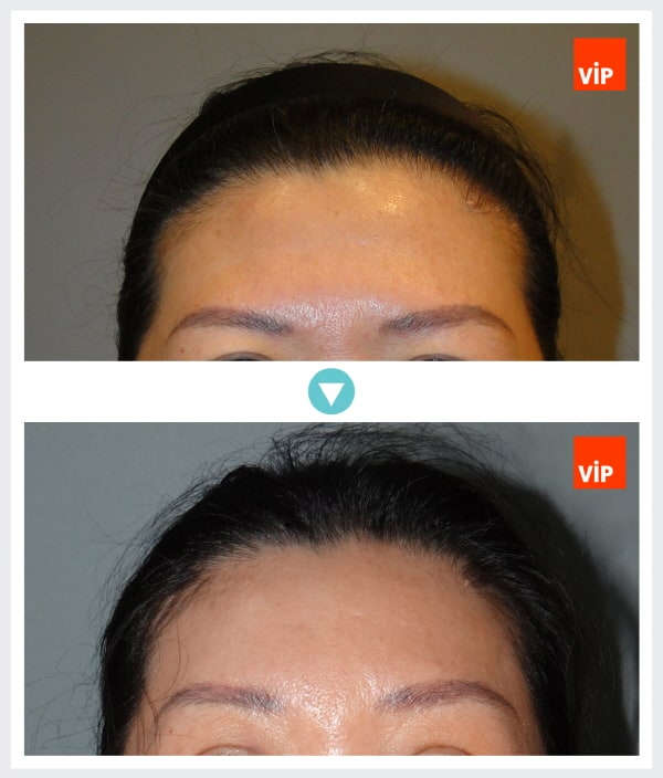 Face Lift - Phẫu thuật nâng trán