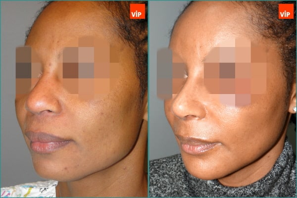 Nose Surgery - Nâng mũi bằng sụn sườn