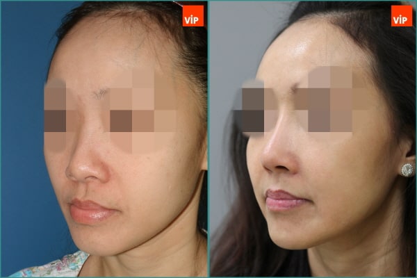 Nose Surgery - Nâng mũi bằng sụn sườn