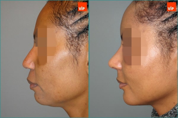 Nose Surgery - Nâng mũi bằng sụn sườn