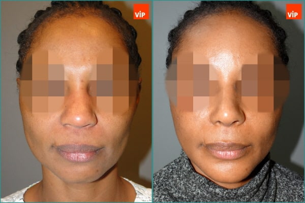 Nose Surgery - Nâng mũi bằng sụn sườn