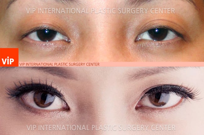 Eye Surgery - Phẫu thuật sa mí mắt