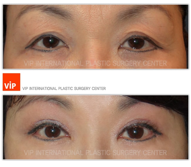 Eye Surgery - Phẫu thuật nâng chân mày