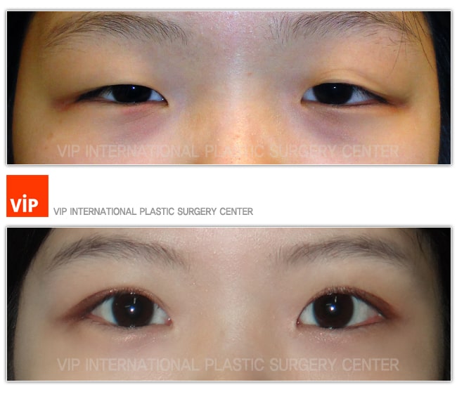 Eye Surgery - Phẫu thuật sa mí mắt