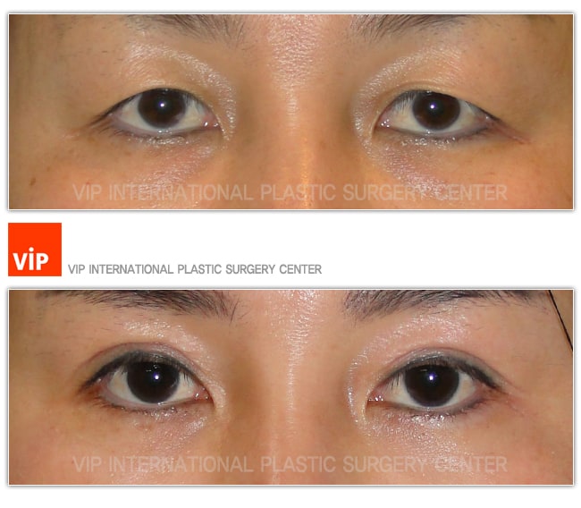 Eye Surgery - Phẫu thuật sa mí mắt