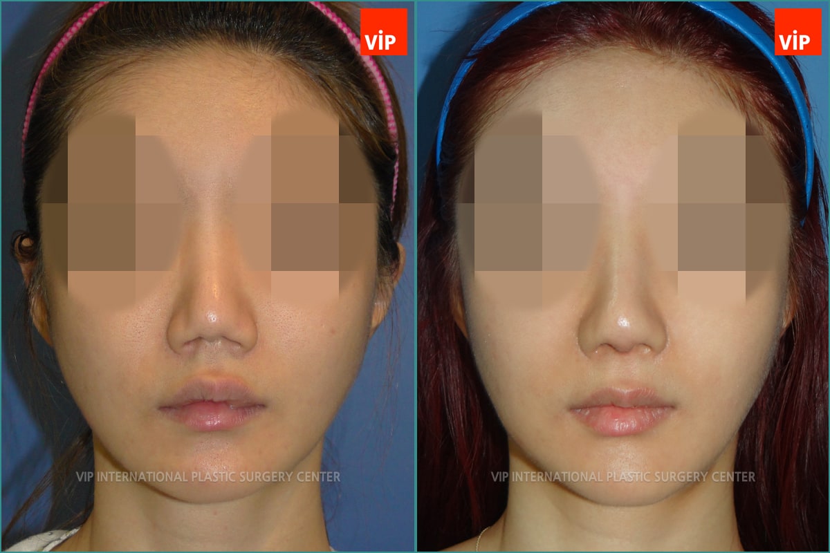 Nose Surgery - Nâng mũi bằng sụn sườn