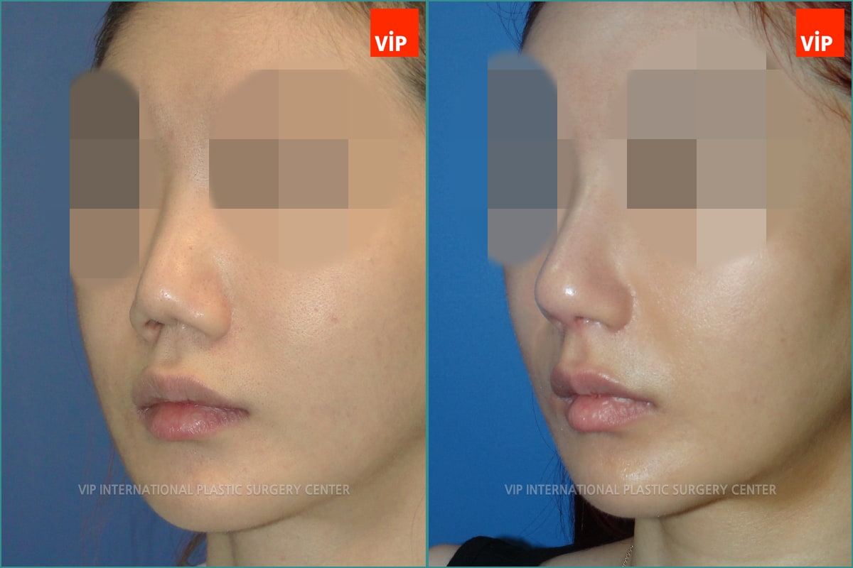 Nose Surgery - Nâng mũi bằng sụn sườn