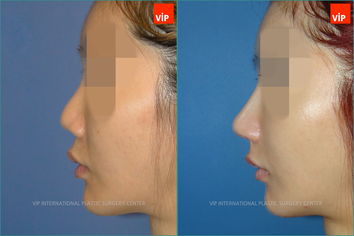 Nose Surgery - Nâng mũi bằng sụn sườn