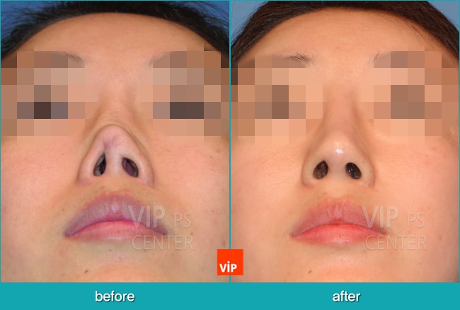 Nose Surgery - Nâng mũi bằng sụn sườn (Tái cấu trúc mũi)