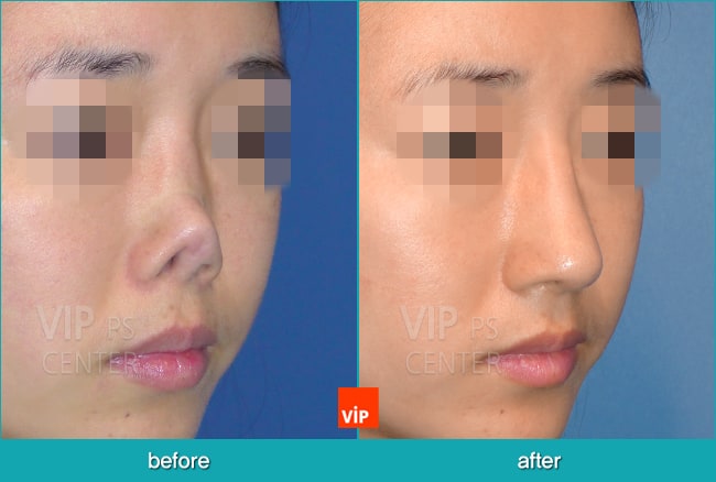 Nose Surgery - Nâng mũi bằng sụn sườn (Tái cấu trúc mũi)