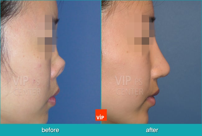 Nose Surgery - Nâng mũi bằng sụn sườn (Tái cấu trúc mũi)