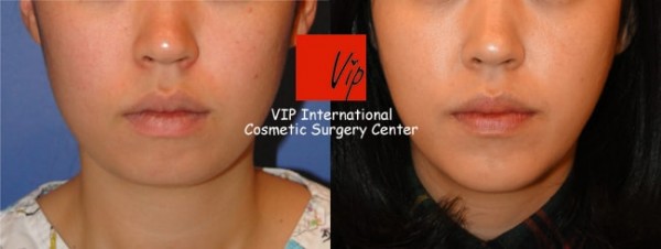 Facial Bone Surgery - Genioplasty