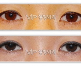 Upper blepharoplasty