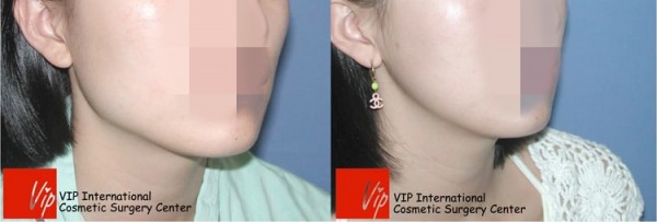 Facial Bone Surgery - Square jaw reduction surgery