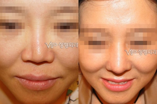 	Harmony-Rhinoplasty, Protruded Mouth Correction Rhinoplasty, Rib cartilage Rhinoplasty	 - Revision- correction of depressed nose with Rib cartilage