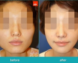 Nâng mũi bằng sụn vách ngăn, Phẫu thuật tạo đường nét trên k…