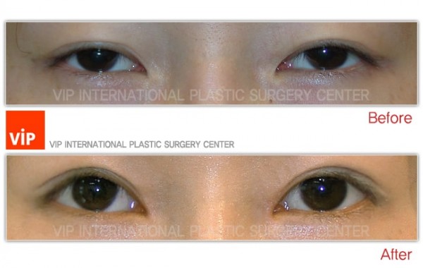 Eye Surgery - Phẫu thuật sa mí  mắt